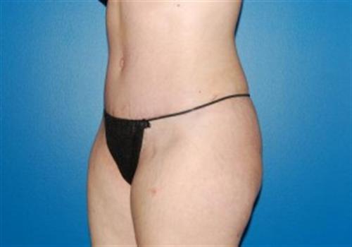 Tummy Tuck Before and After | SGK Plastic Surgery