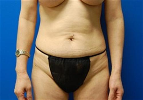 Tummy Tuck Before and After | SGK Plastic Surgery