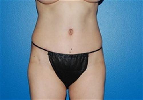 Tummy Tuck Before and After | SGK Plastic Surgery