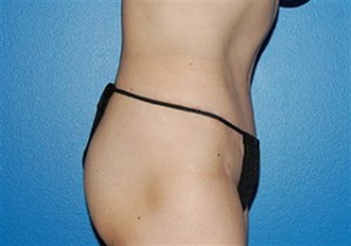 Tummy Tuck Before and After | SGK Plastic Surgery