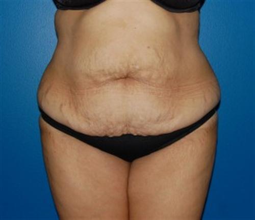 Tummy Tuck Before and After | SGK Plastic Surgery