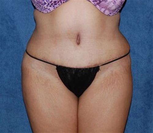 Tummy Tuck Before and After | SGK Plastic Surgery