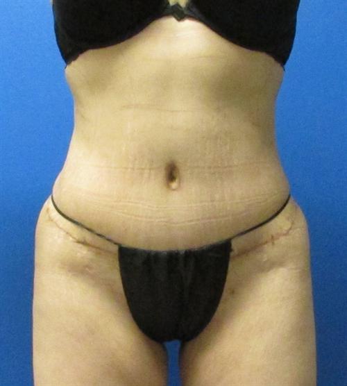 Tummy Tuck Before and After | SGK Plastic Surgery