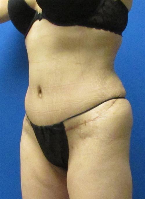 Tummy Tuck Before and After | SGK Plastic Surgery