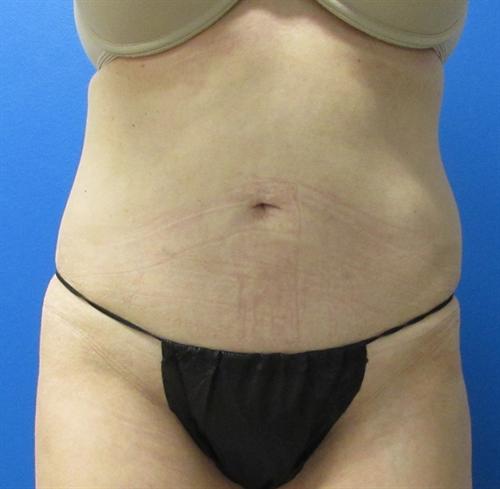 Tummy Tuck Before and After | SGK Plastic Surgery