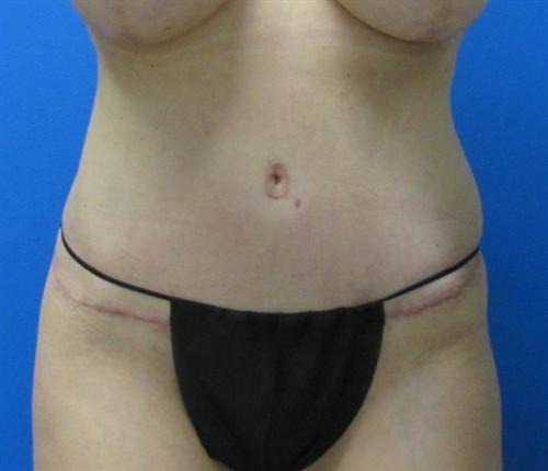 Tummy Tuck Before and After | SGK Plastic Surgery