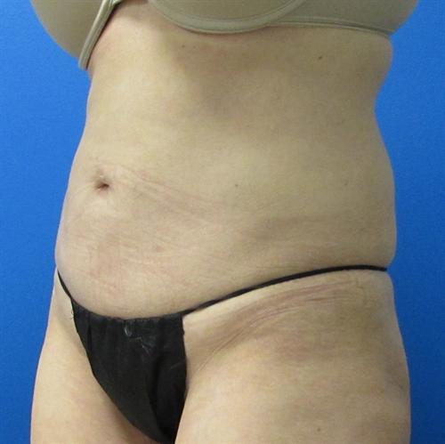 Tummy Tuck Before and After | SGK Plastic Surgery