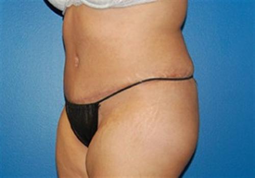 Tummy Tuck Before and After | SGK Plastic Surgery