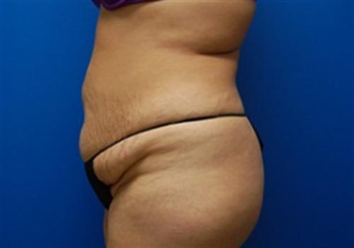 Tummy Tuck Before and After | SGK Plastic Surgery