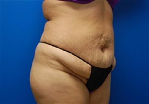 Tummy Tuck Before and After | SGK Plastic Surgery