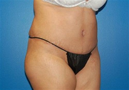 Tummy Tuck Before and After | SGK Plastic Surgery