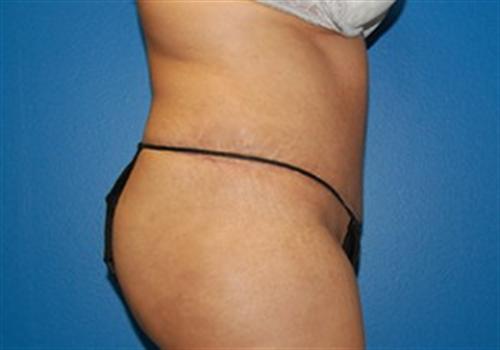 Tummy Tuck Before and After | SGK Plastic Surgery