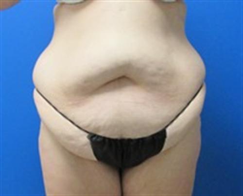 Tummy Tuck Before and After | SGK Plastic Surgery