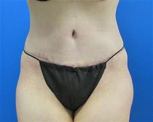 Tummy Tuck Before and After | SGK Plastic Surgery