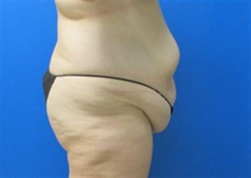 Tummy Tuck Before and After | SGK Plastic Surgery