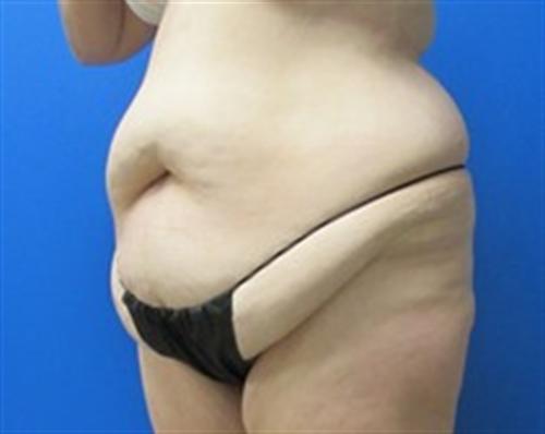 Tummy Tuck Before and After | SGK Plastic Surgery