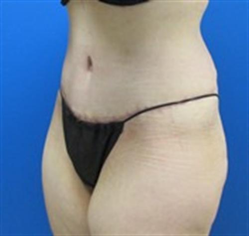 Tummy Tuck Before and After | SGK Plastic Surgery