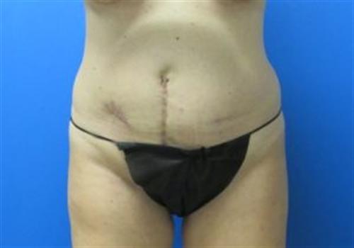 Tummy Tuck Before and After | SGK Plastic Surgery