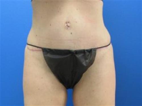 Tummy Tuck Before and After | SGK Plastic Surgery