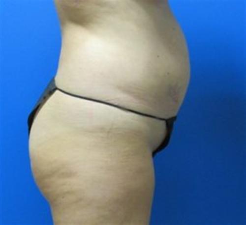 Tummy Tuck Before and After | SGK Plastic Surgery