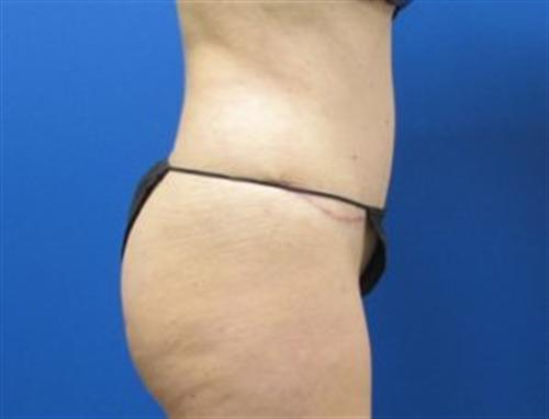 Tummy Tuck Before and After | SGK Plastic Surgery