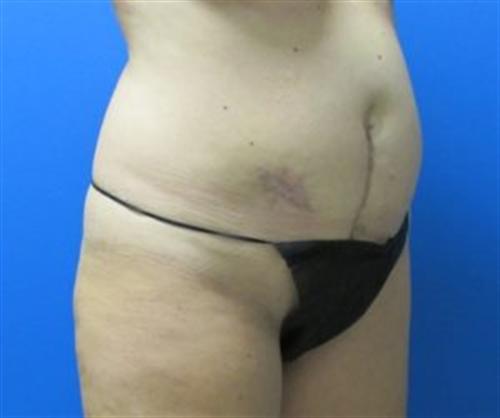 Tummy Tuck Before and After | SGK Plastic Surgery