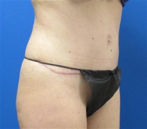 Tummy Tuck Before and After | SGK Plastic Surgery