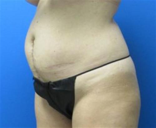 Tummy Tuck Before and After | SGK Plastic Surgery