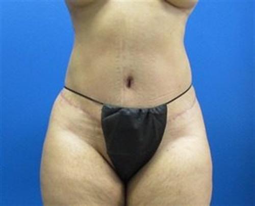 Tummy Tuck Before and After | SGK Plastic Surgery