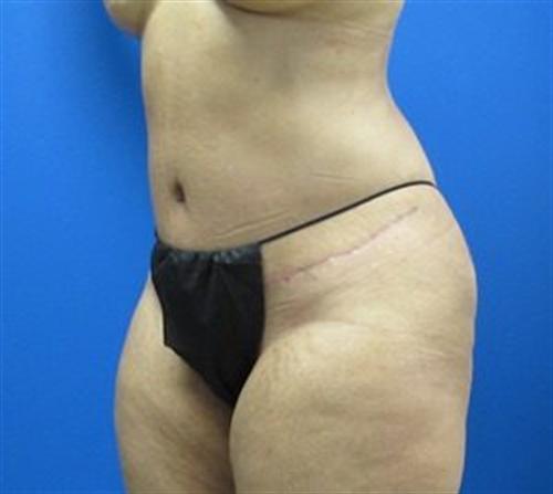 Tummy Tuck Before and After | SGK Plastic Surgery