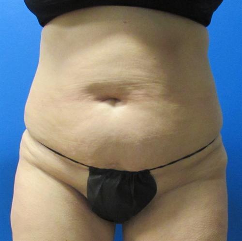 Tummy Tuck Before and After | SGK Plastic Surgery