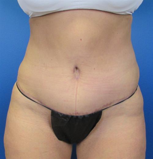 Tummy Tuck Before and After | SGK Plastic Surgery