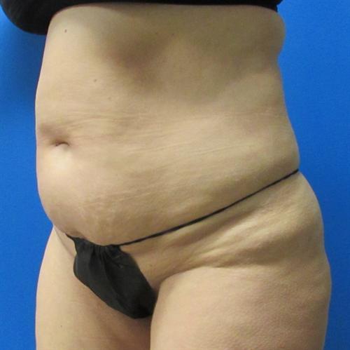 Tummy Tuck Before and After | SGK Plastic Surgery