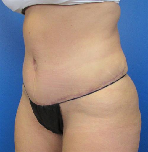 Tummy Tuck Before and After | SGK Plastic Surgery