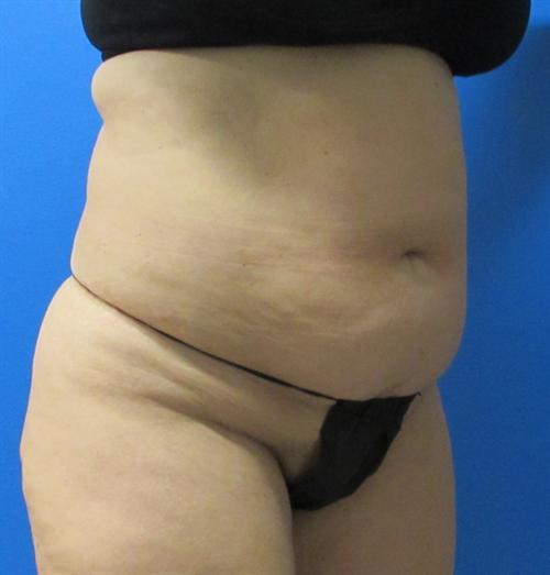 Tummy Tuck Before and After | SGK Plastic Surgery