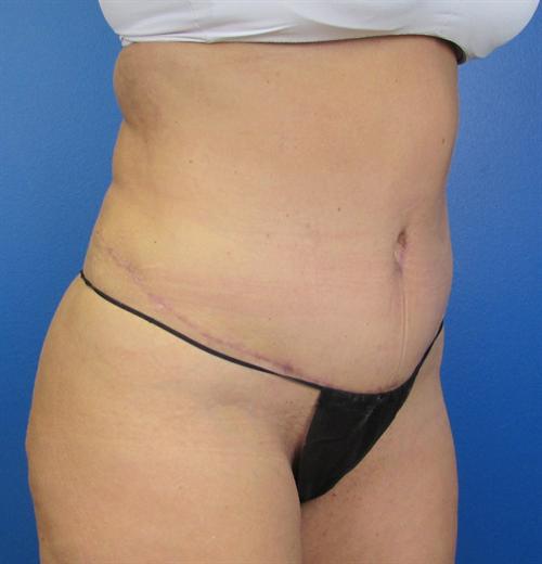 Tummy Tuck Before and After | SGK Plastic Surgery