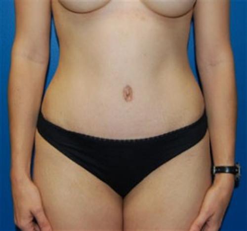 Tummy Tuck Before and After | SGK Plastic Surgery