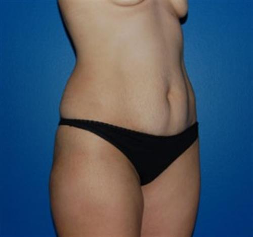 Tummy Tuck Before and After | SGK Plastic Surgery