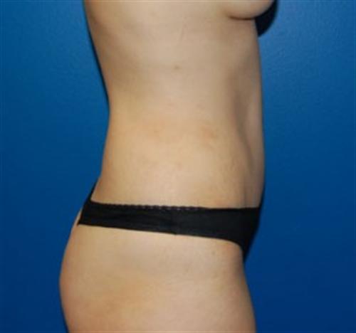 Tummy Tuck Before and After | SGK Plastic Surgery