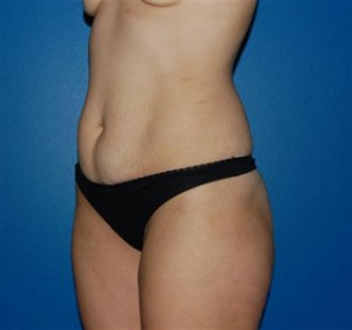 Tummy Tuck Before and After | SGK Plastic Surgery