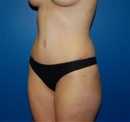 Tummy Tuck Before and After | SGK Plastic Surgery