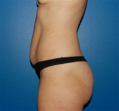 Tummy Tuck Before and After | SGK Plastic Surgery
