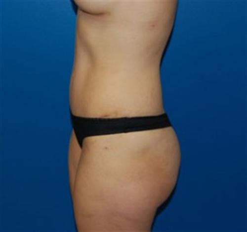 Tummy Tuck Before and After | SGK Plastic Surgery