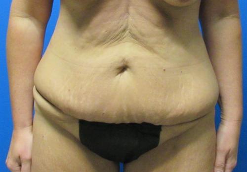 Tummy Tuck Before and After | SGK Plastic Surgery