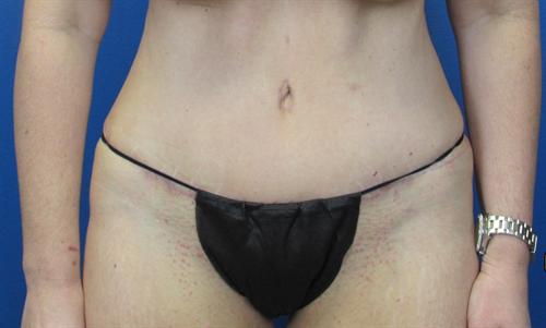 Tummy Tuck Before and After | SGK Plastic Surgery