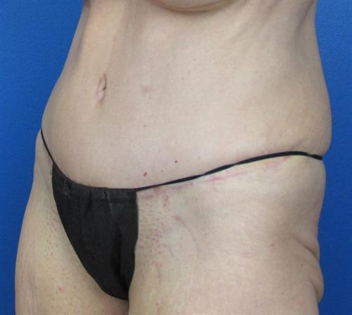 Tummy Tuck Before and After | SGK Plastic Surgery