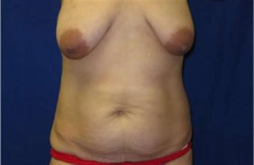 Tummy Tuck Before and After | SGK Plastic Surgery