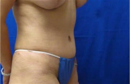 Tummy Tuck Before and After | SGK Plastic Surgery