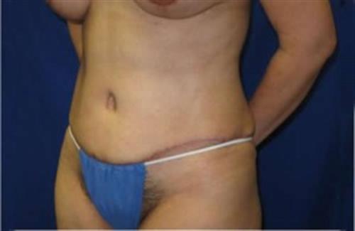 Tummy Tuck Before and After | SGK Plastic Surgery