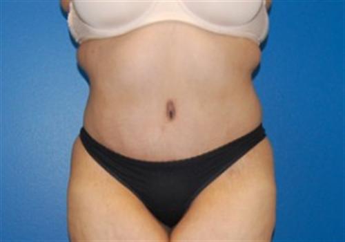 Tummy Tuck Before and After | SGK Plastic Surgery